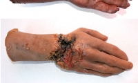 Decayed Hand and Wrist