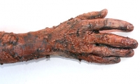Decayed Arm and Hand