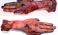 Burnt Hand and Wrist