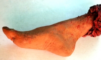 Foot and Ankle