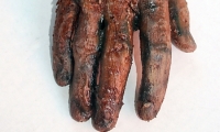 Burnt Arm and Hand