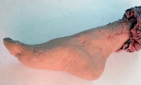Foot and Ankle