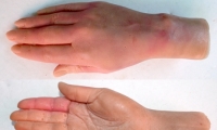 Hand and Wrist