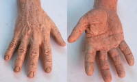 Hand and Wrist