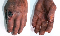 Hand and Wrist