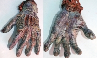 Burnt Hand